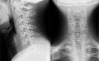 Ostéopathie: Traitement des Cervicalgies et Ostéopathie